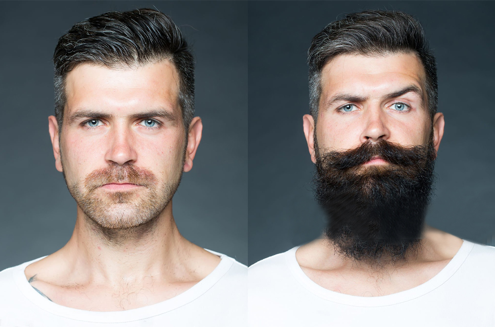 Patchy Beard Befor After